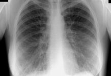 Рентген легких: что показывает, как подготовиться и где сделать